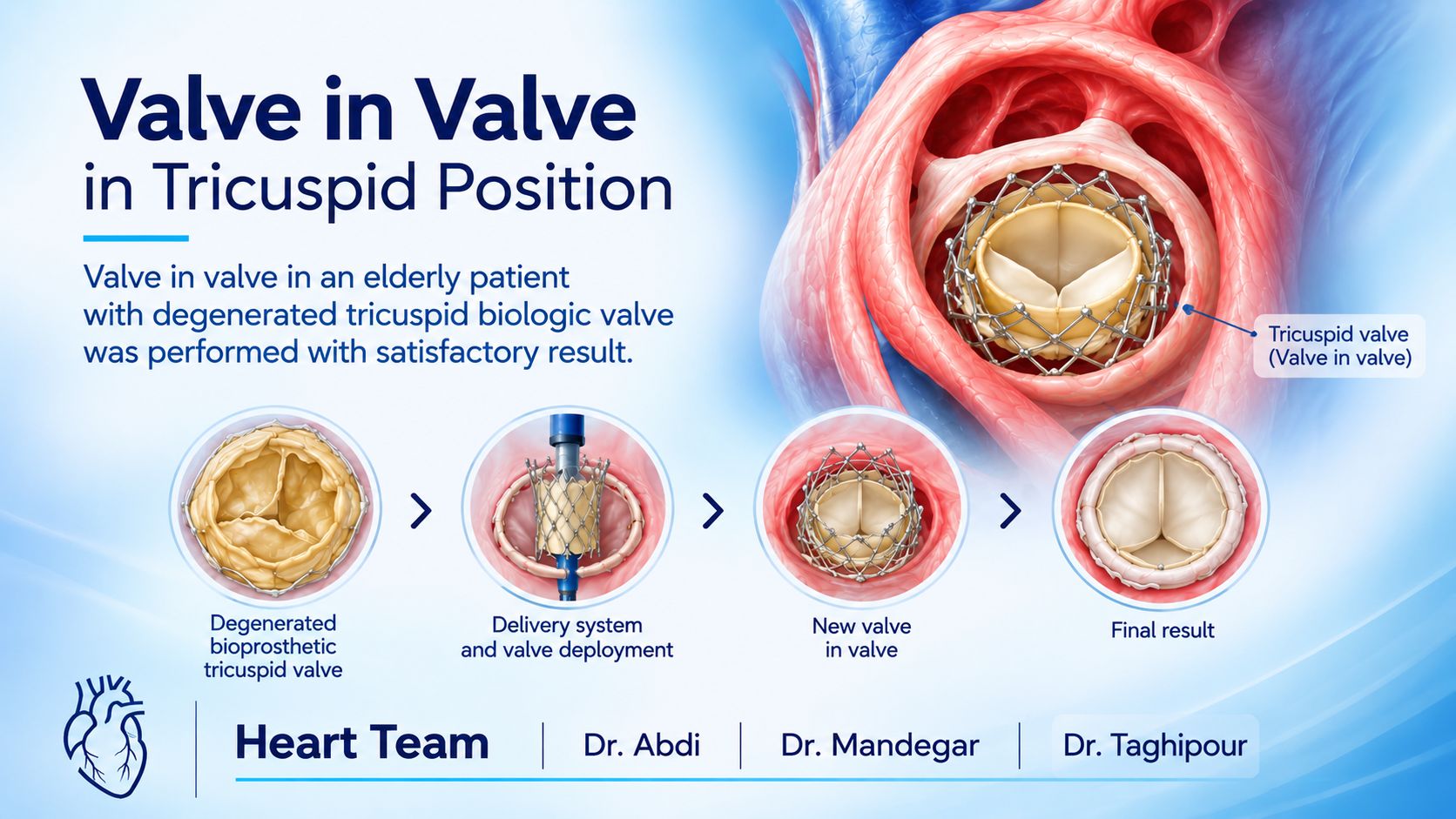 درمان کم‌تهاجمی تخریب دریچه تریکوسپید با روش Valve-in-Valve؛ بدون جراحی باز مجدد قلب